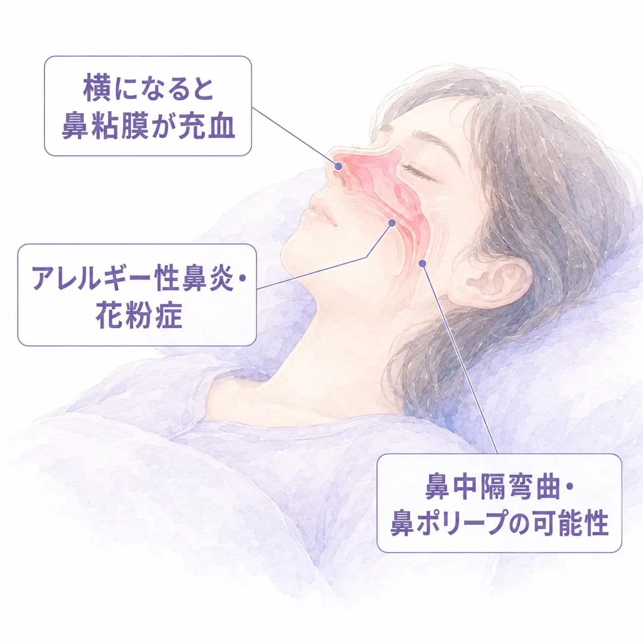 鼻づまりの原因（横になると鼻粘膜が充血・アレルギー性鼻炎や花粉症・鼻中隔弯曲や鼻ポリープの可能性）