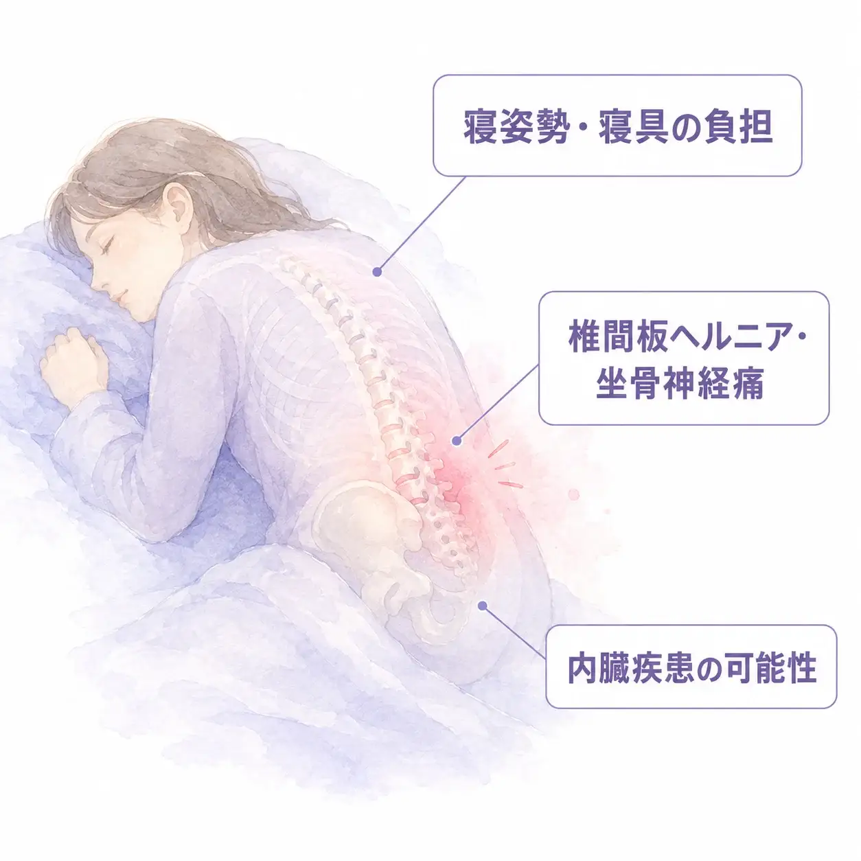 朝方の腰痛の原因（寝姿勢・寝具・椎間板ヘルニア・内臓疾患）の図解イメージ