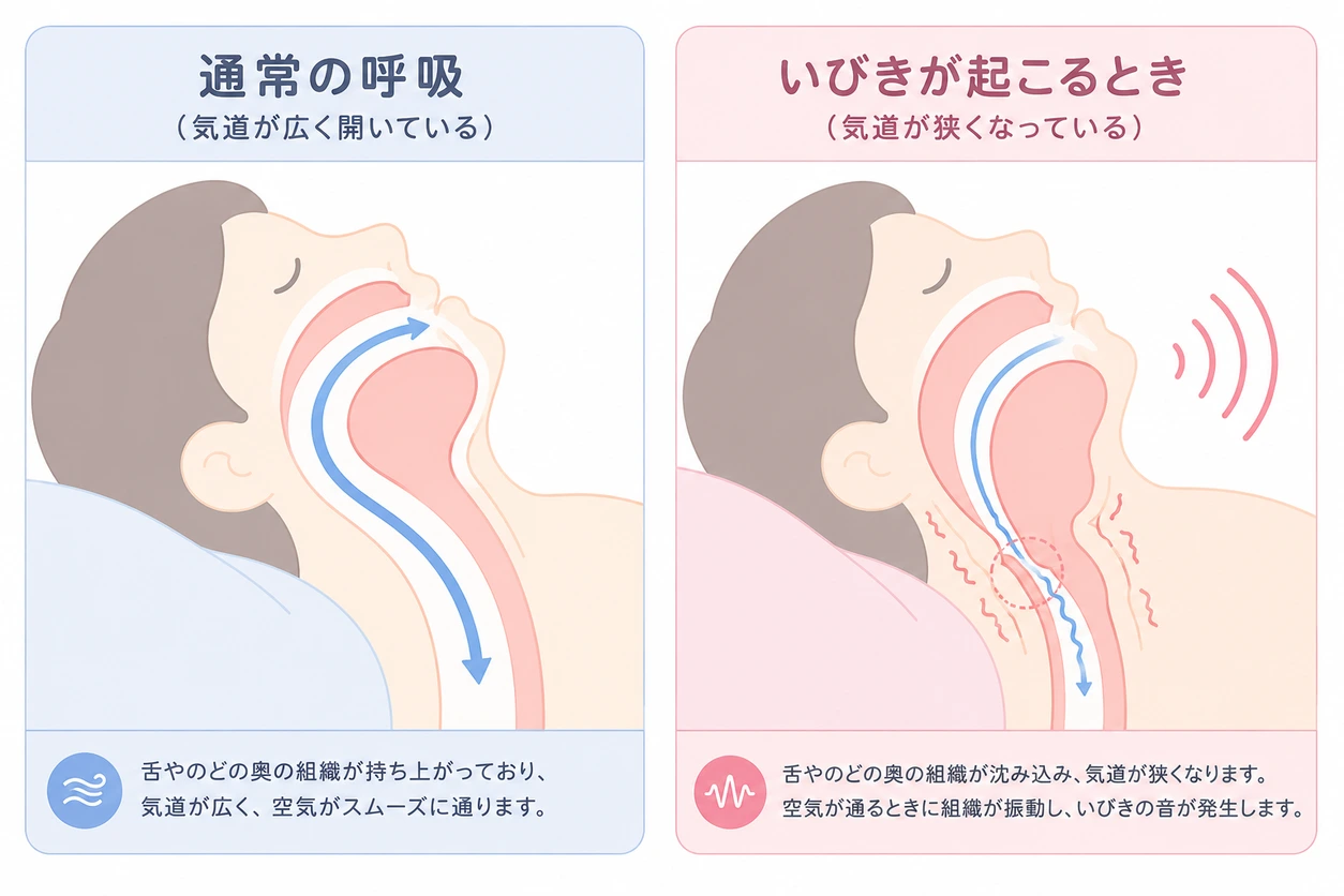 いびきが起きる仕組み（通常の呼吸といびき時の気道の違い）